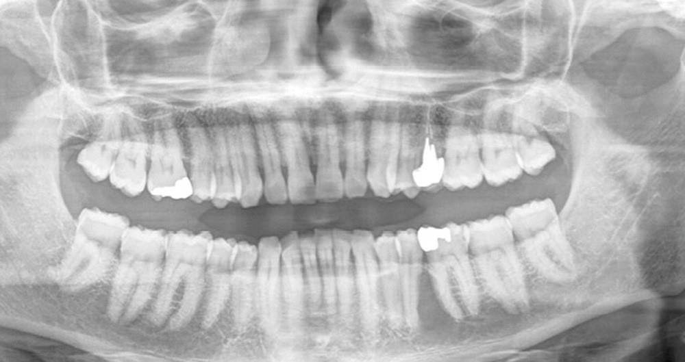 Radiographie panoramique dentaire
